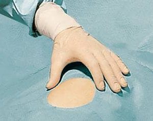 Campuri chirurgicale cu orificiu autoadeziv Foliodrape Protect 1 Campuri chirurgicale cu orificiu autoadeziv Foliodrape Protect